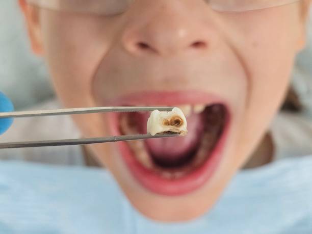 Best Emergency Dental Extractions in Ponca City, OK